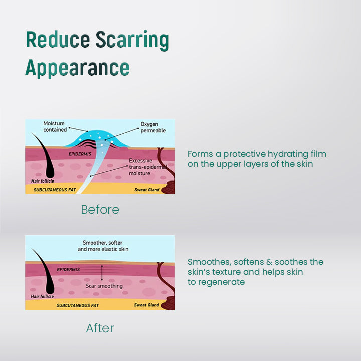 ScarXpert™ Advanced Scar Removal Gel