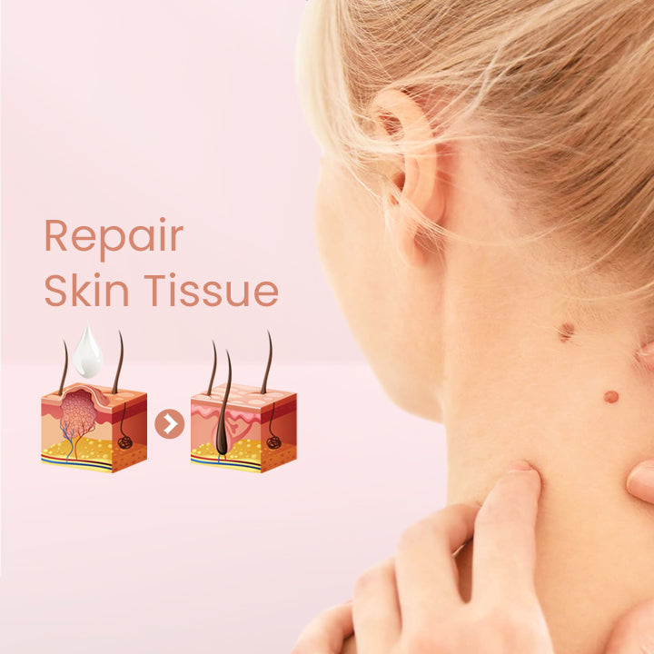 Herbal Wart Skin Removal Ointment