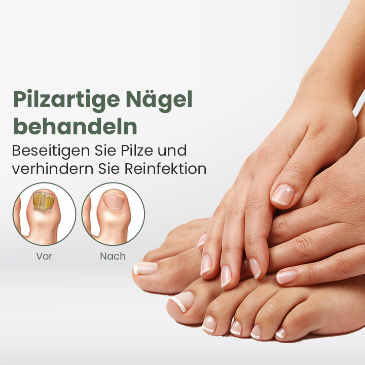 LifeMed Home Verwendung Onychomykose Pilz-Laser-Behandlung