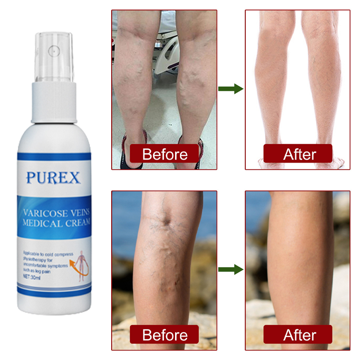 VeinDefense™ Varicose Treatment Spray