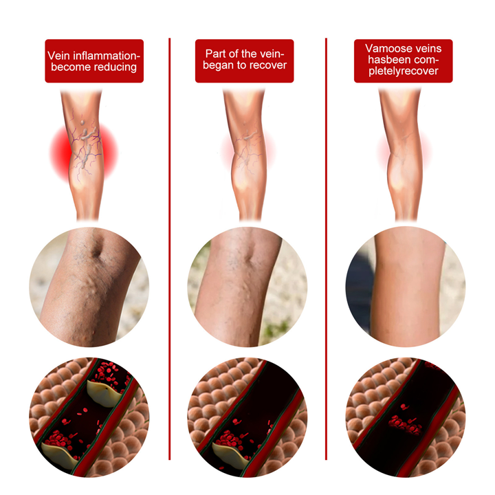 VeinDefense™ Varicose Treatment Spray