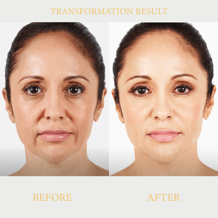 EyeLift™ Ionic Contouring System