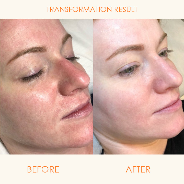SkinRenew™ Blemish Corrector Serum