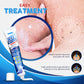 Painless Wart Skin Remover