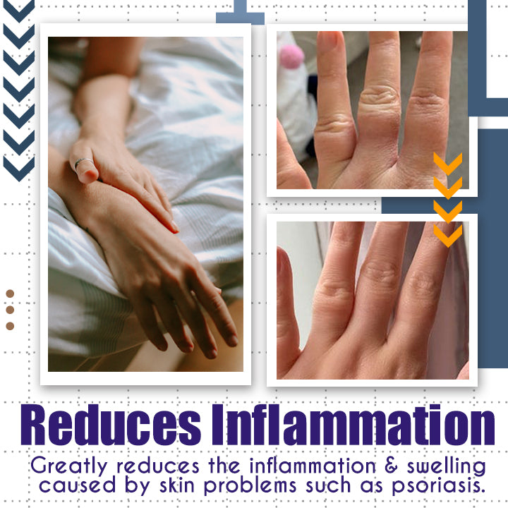 LaCure™ Eczema Calming Cream